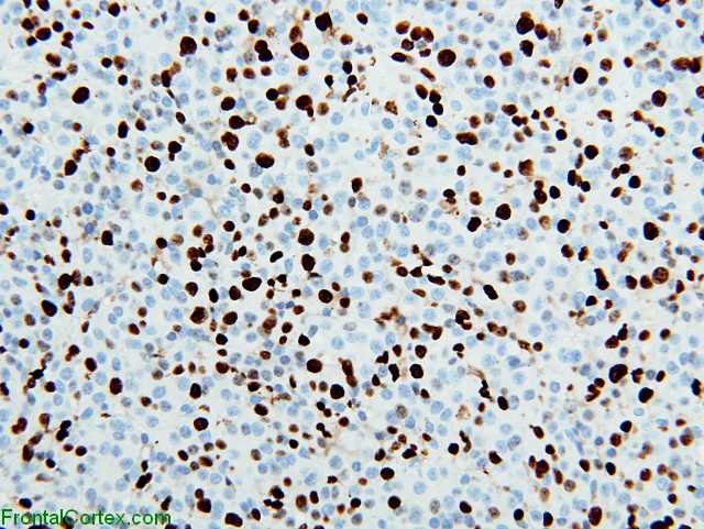 Atypical pituitary adenoma Ki-67 x200